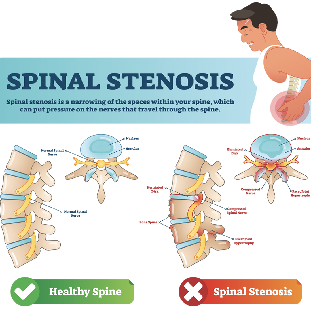 https://mdashishpatel.com/wp-content/uploads/2021/03/spinal-stenosis.jpg
