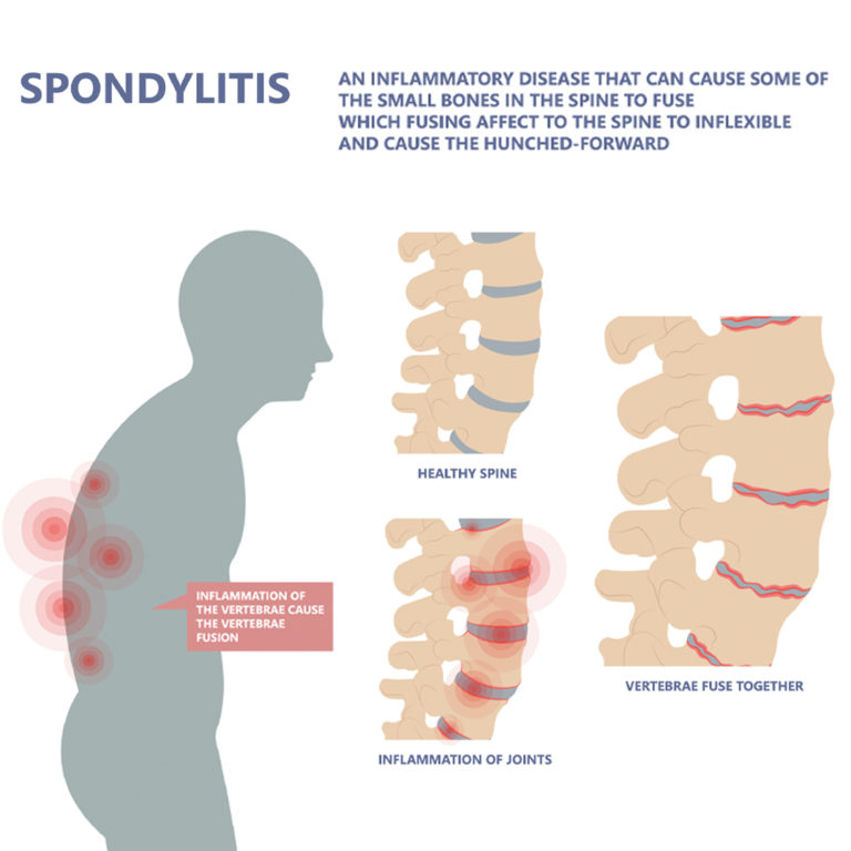 Spondylolysis