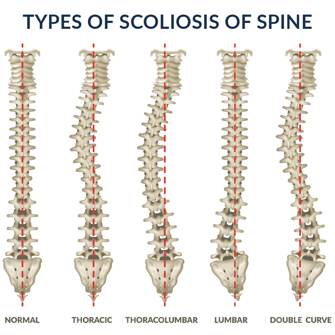 https://mdashishpatel.com/wp-content/uploads/2021/03/types-of-scoliosis-of-spine.jpg