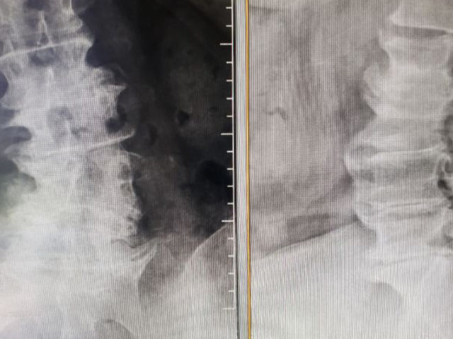 https://mdashishpatel.com/wp-content/uploads/2021/07/Lordosis-Restoration-When-Using-The-Prone-Lateral-Technique-Featured-640x480.jpg