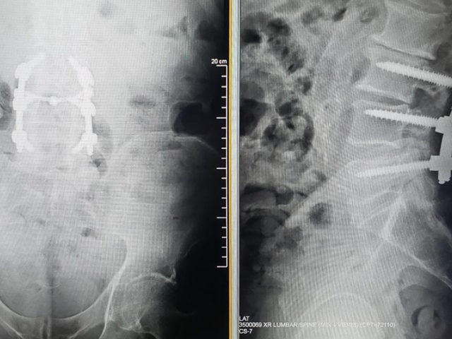 https://mdashishpatel.com/wp-content/uploads/2021/07/Older-Gentlemen-With-Hx-Of-Two-Previous-Spine-Surgeries-Featured-640x480.jpg