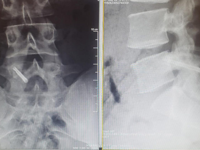 https://mdashishpatel.com/wp-content/uploads/2021/07/Pediatric-Athlete-Spine-Case-Featured-640x480.jpg