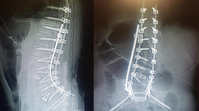 Restoring Sagittal Spinal Alignment Plan