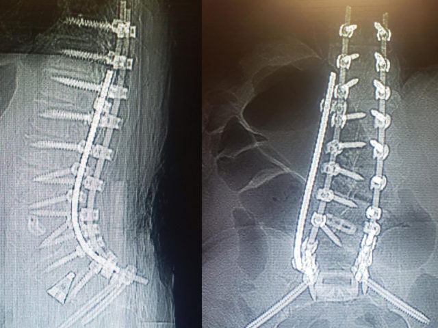 https://mdashishpatel.com/wp-content/uploads/2021/07/Restoring-Sagittal-Spinal-Alignment-Plan-Featured-640x480.jpg