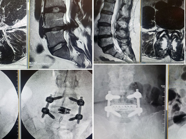 https://mdashishpatel.com/wp-content/uploads/2021/07/Three-Patients-with-L4-5-Issues-Benefit-from-Surgical-Management-Featured-640x480.jpg